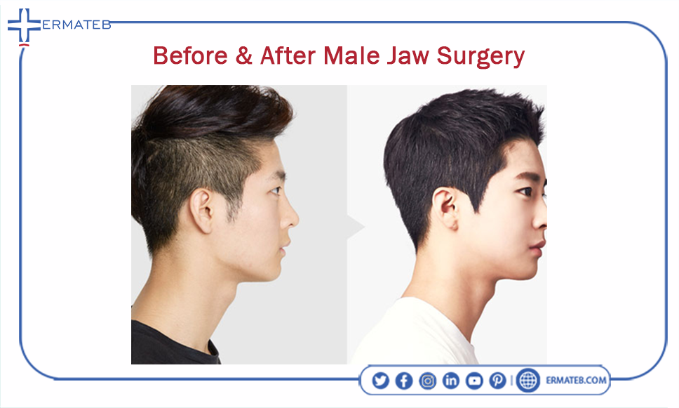 before & after Male Jaw Surgery